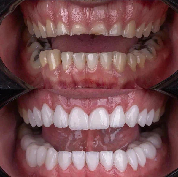 Facetas Odontológicas Removíveis