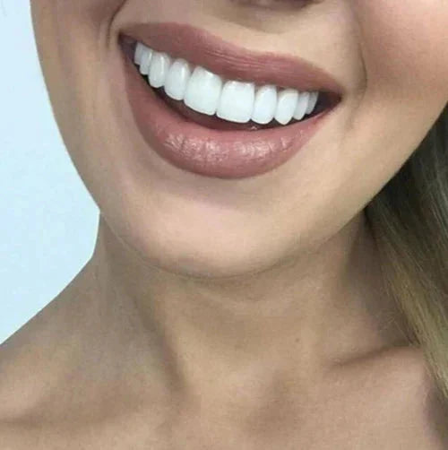 Facetas Odontológicas Removíveis