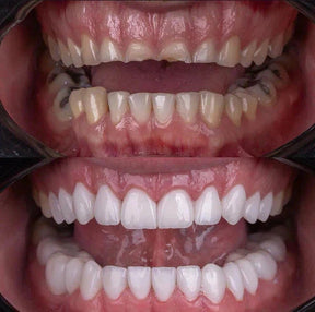 Facetas Odontológicas Removíveis