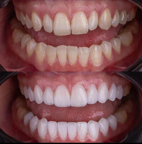 Facetas Odontológicas Removíveis